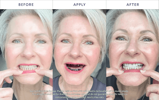 👨⚕️Purple Teeth Whitening Strips:Revolutionary Dissolving Diamond Series Technology with Hydroxyapatite 💎