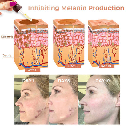 ✨Fast Dark Spot Remover-NESLEMY™  Correcting Facial Serum