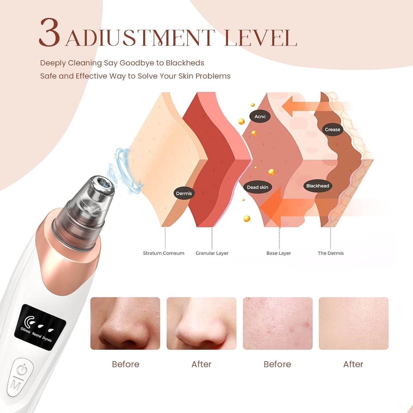 🔥2025 Blackhead Remover Pore Vacuum,Facial Pore Cleaner-5 Suction Power,5 Probes,USB Rechargeable Blackhead Vacuum Kit Electric🔥🔥