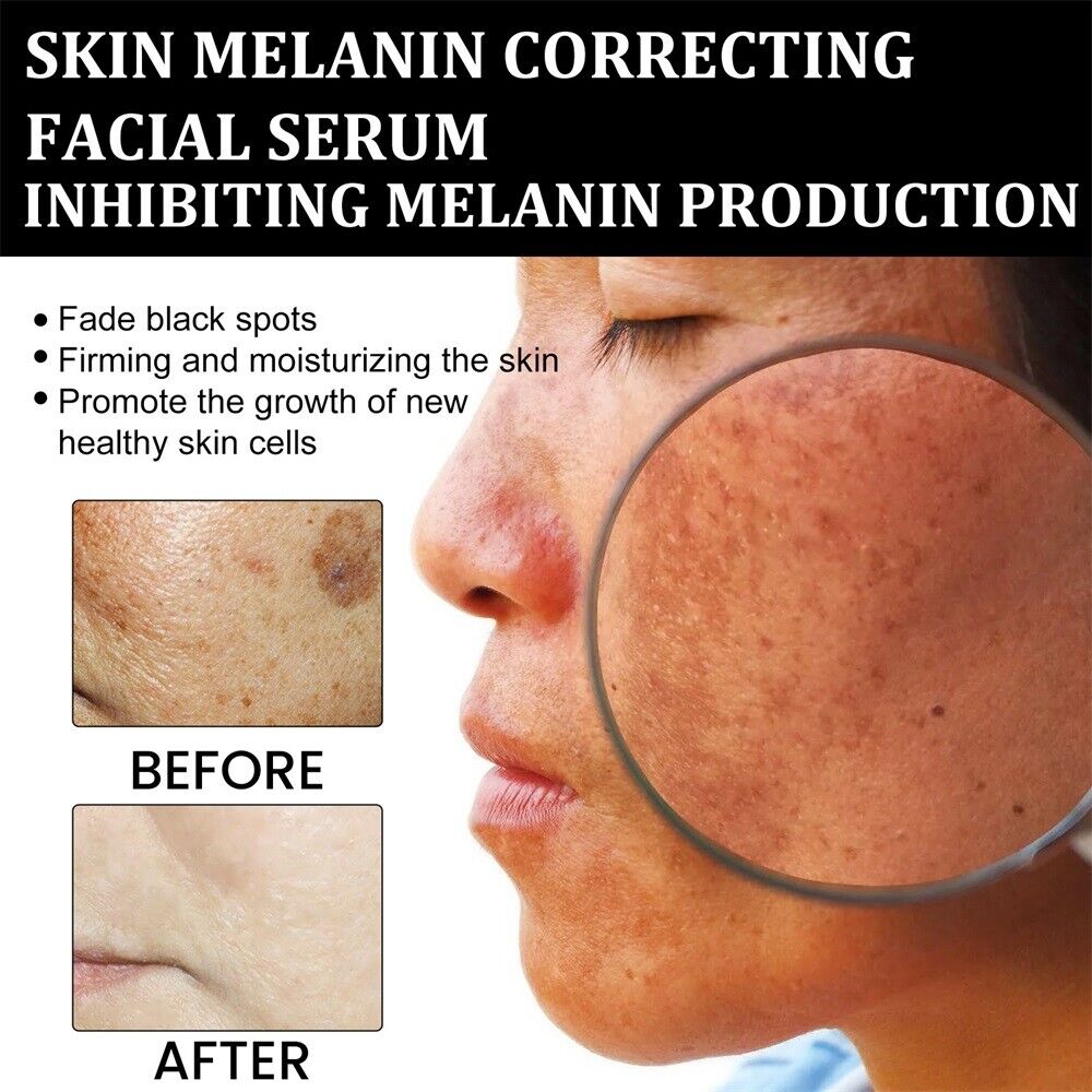 ✨Fast Dark Spot Remover-NESLEMY™  Correcting Facial Serum